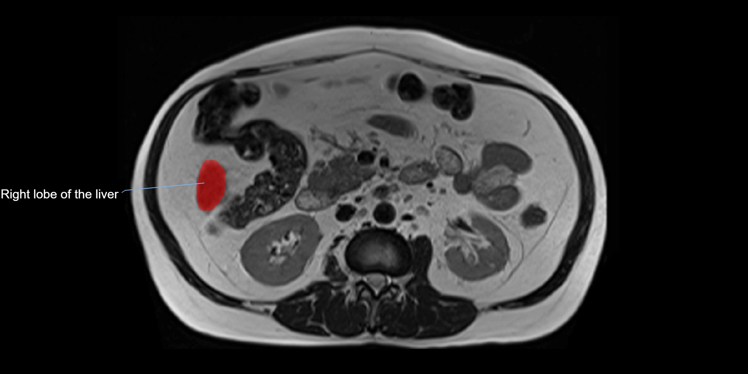 MRI liver lobe axial cross sectional 3T radiology  image-img-00001-00023.webp